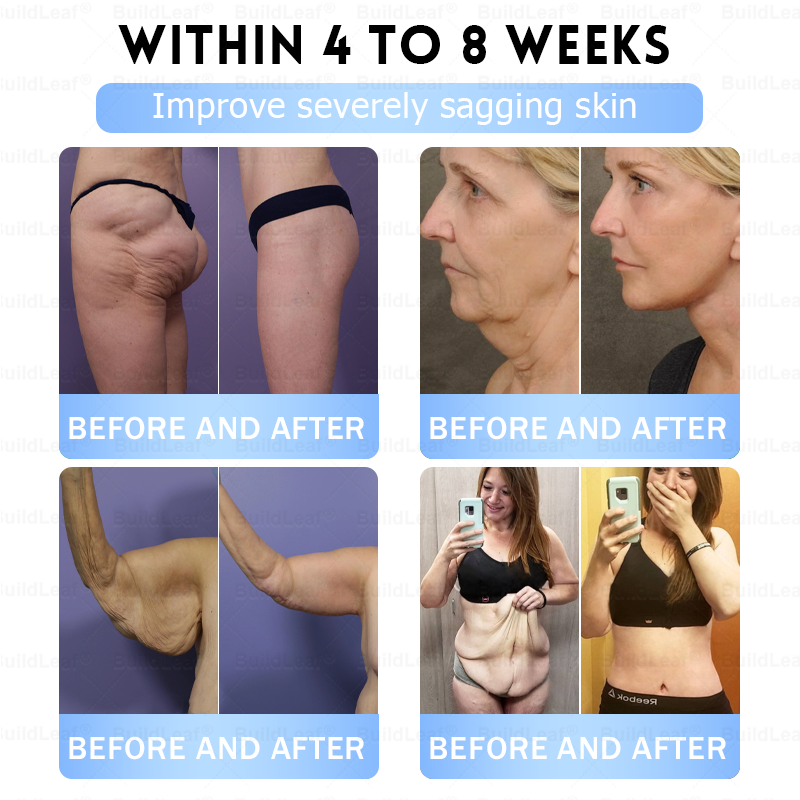 Official FDA Store·𝐁𝐮𝐢𝐥𝗱𝐋𝐞𝐚𝐟®𝐒𝐥𝐢𝐦 & 𝐅𝐢𝐫𝐦 𝐍𝐚𝐧𝐨 𝐌𝐢𝐜𝐫𝐨𝐧𝐞𝐞𝐝𝐥𝐞 𝐏𝐚𝐭𝐜𝐡 𝐰𝐢𝐭𝐡 𝐌𝐨𝐫𝐢𝐧𝐠𝐚, 𝐎𝐦𝐞𝐠𝐚-𝟑, 𝐂𝐨𝐥𝐥𝐚𝐠𝐞𝐧 𝐏𝐞𝐩𝐭𝐢𝐝𝐞𝐬, 𝐍𝐀𝐃 & 𝐍𝐌𝐍 𝐟𝐨𝐫 𝐎𝐛𝐞𝐬𝐢𝐭𝐲, 𝐂𝐚𝐫𝐝𝐢𝐨𝐯𝐚𝐬𝐜𝐮𝐥𝐚𝐫 𝐃𝐢𝐬𝐞𝐚𝐬𝐞, 𝐃𝐢𝐚𝐛𝐞𝐭𝐞𝐬, 𝐒𝐥𝐞𝐞𝐩 𝐀𝐩𝐧𝐞𝐚, 𝐉𝐨𝐢𝐧𝐭 𝐏𝐫𝐨𝐛𝐥𝐞𝐦𝐬, 𝐒𝐤𝐢𝐧 𝐅𝐢𝐫𝐦𝐢𝐧𝐠, 𝐀𝐧𝐭𝐢-𝐀𝐠𝐢𝐧𝐠, 𝐚𝐧𝐝 𝐌𝐨𝐫𝐞